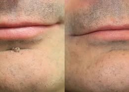 Biancat®2-in-1 Microneedle & Hydrocolloid Patch🍀| Removes Raised Moles, Acne, Flat Warts & Skin Tags | Helps Improve Wrinkles, Scars & Blemishes | Invisible Patches for Face & Body