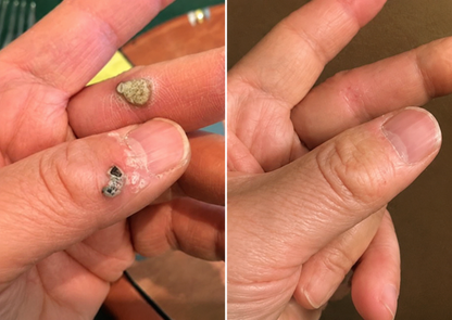 Biancat®2-in-1 Microneedle & Hydrocolloid Patch🍀| Removes Raised Moles, Acne, Flat Warts & Skin Tags | Helps Improve Wrinkles, Scars & Blemishes | Invisible Patches for Face & Body